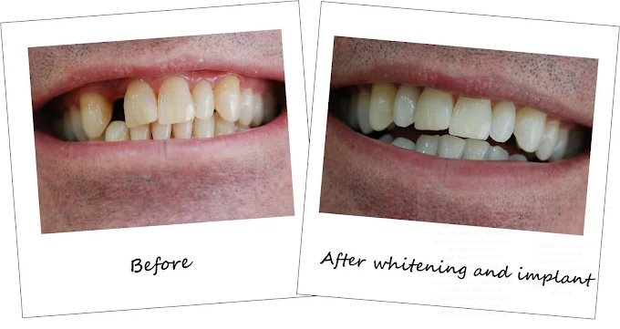Before and after dental implant results