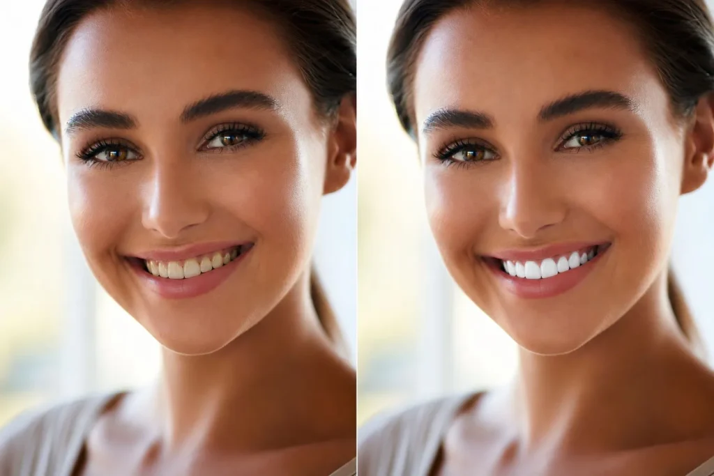 Before and after teeth scaling in Lahore