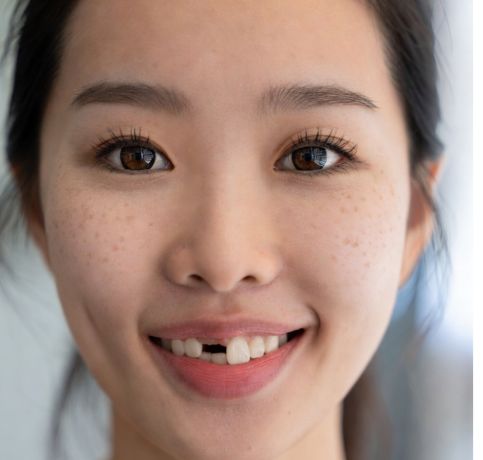 Missing teeth dental problem