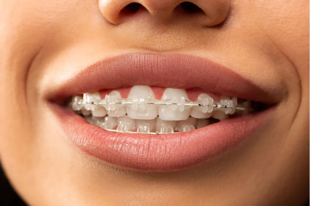 Ceramic braces type