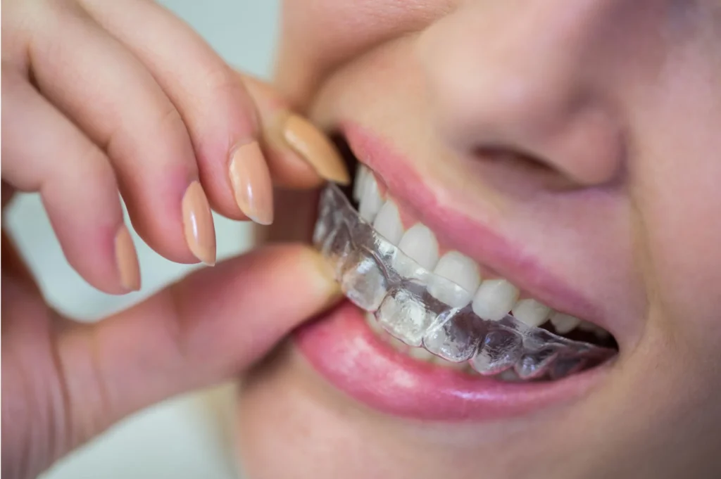 Invisalign and clear aligners