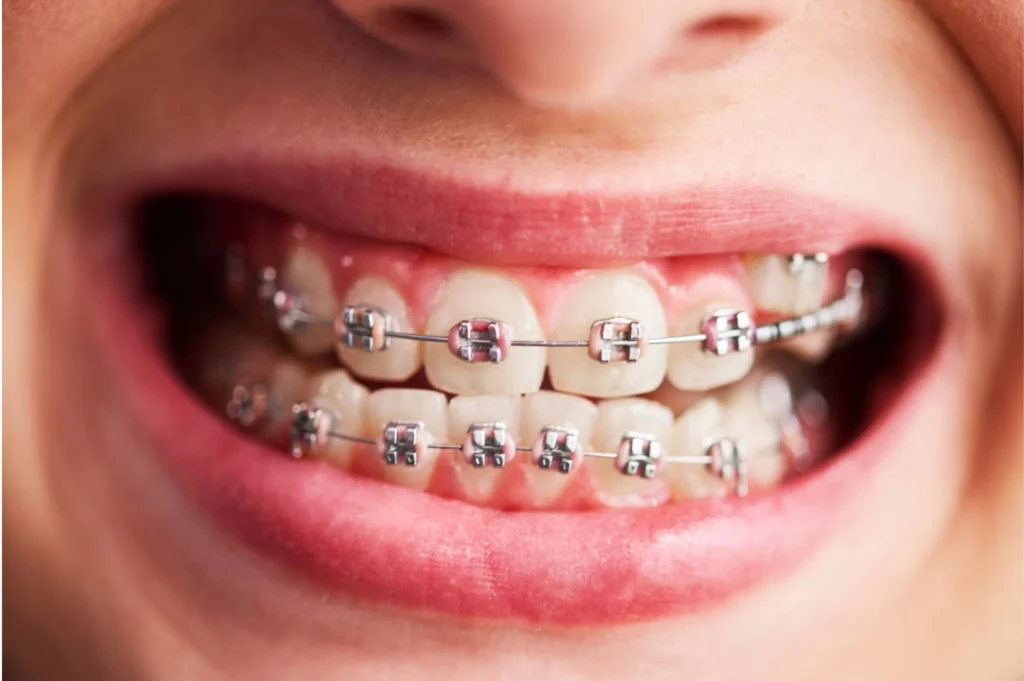 Self ligating braces