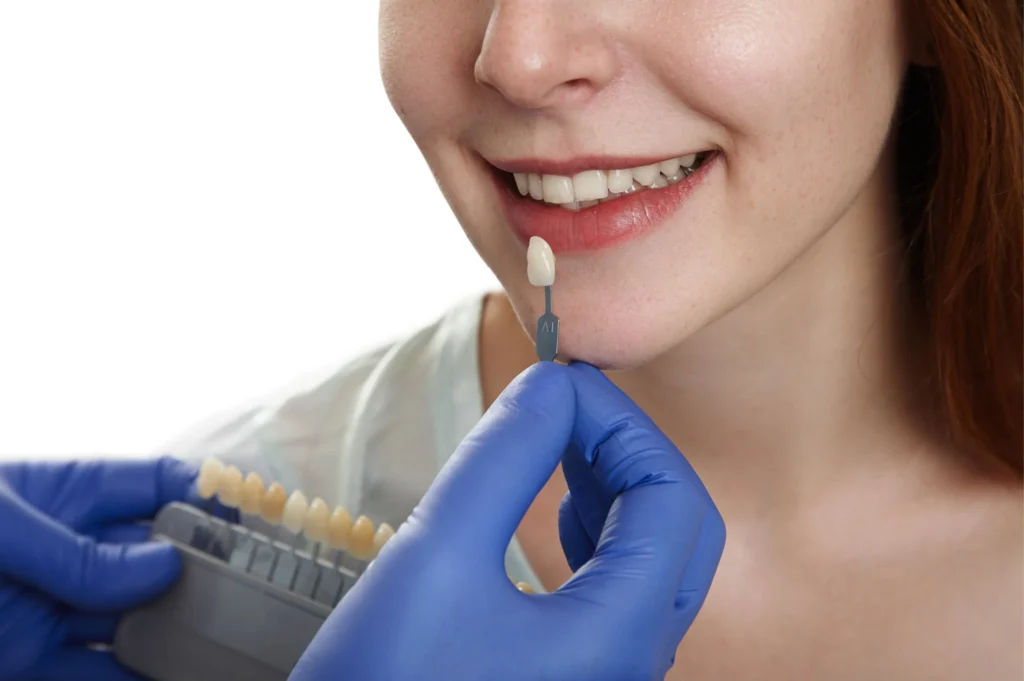 Teeth veneers in Lahore at International Dental Hub