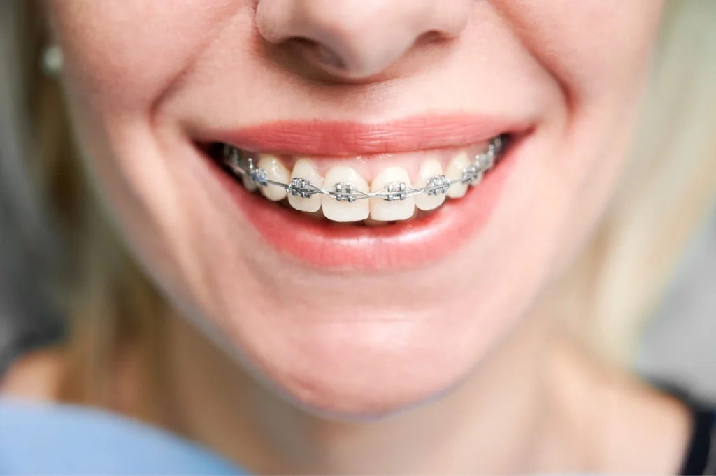 Metal braces type