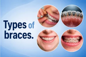 Types of teeth braces at International Dental Hub