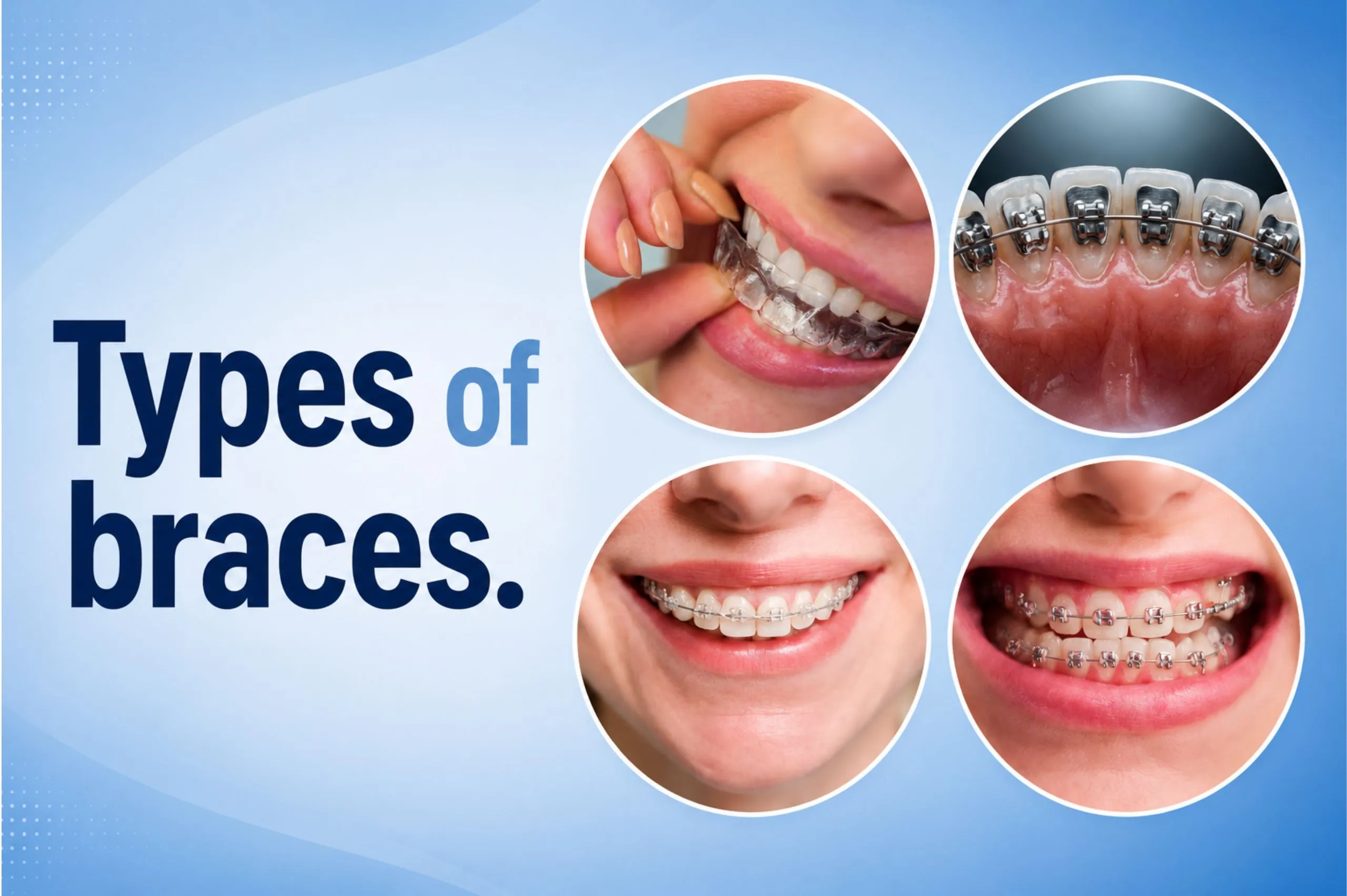 Types of teeth braces at International Dental Hub