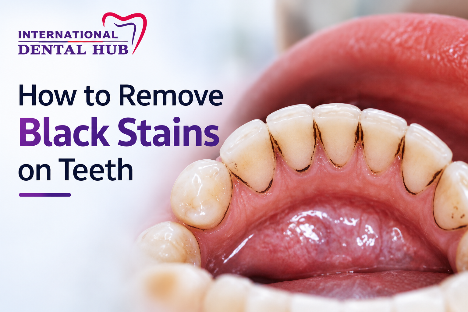 black stains on teeth and how to remove them