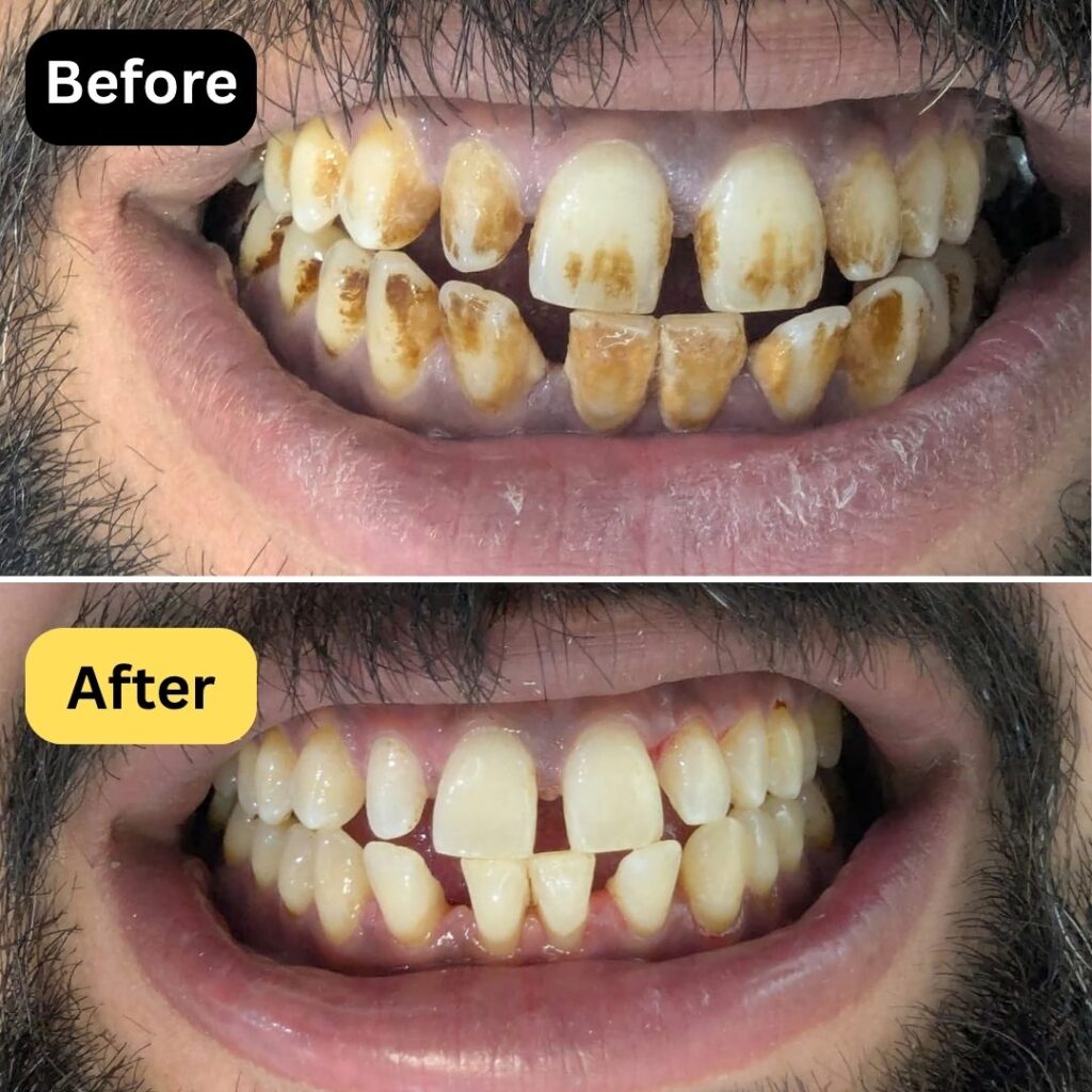 Teeth scaling and polishing in Bahria town lahore