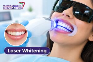 How long does laser whitening last